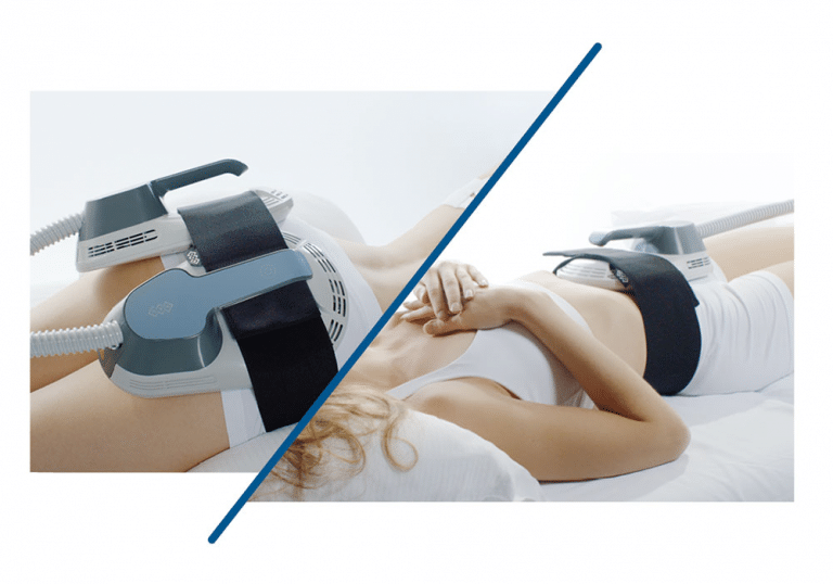 Body Sculpt sa RF podrškom